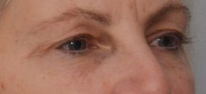 Blepharoplasty Before & After Patient #1704