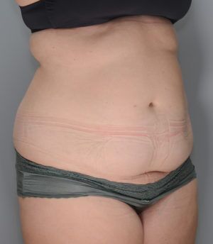 Abdominoplasty Before & After Patient #1271