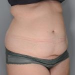 Abdominoplasty Before & After Patient #1643