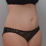 Abdominoplasty Before & After Patient #1387