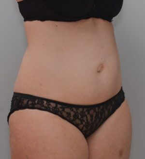 Abdominoplasty Before & After Patient #1387