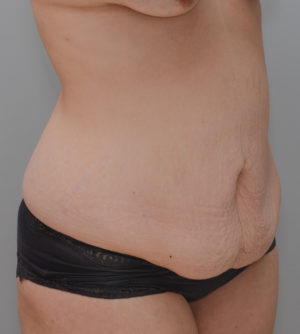 Abdominoplasty Before & After Patient #1440