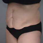 Abdominoplasty Before & After Patient #1210