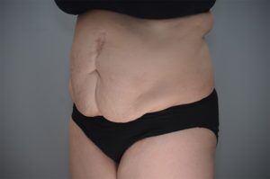 Abdominoplasty Before & After Patient #1210