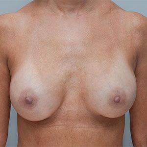 Breast Implant Exchange Before & After Patient #861