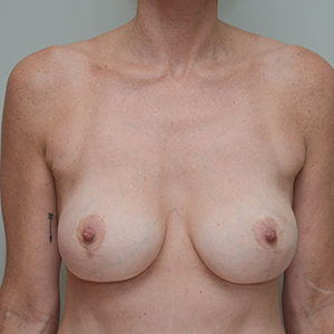 Breast Augmentation Before & After Patient #247