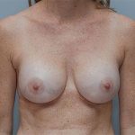 Breast Implant Exchange Before & After Patient #862