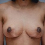 Breast Lift Before & After Patient #900