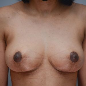 Breast Lift Before & After Patient #900