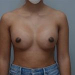 Breast Augmentation Before & After Patient #248