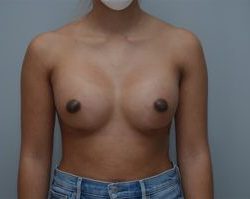 Breast Augmentation Before & After Patient #248