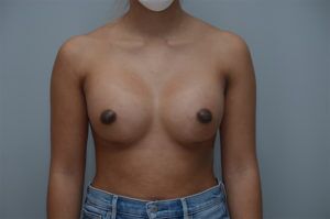 Breast Augmentation Before & After Patient #248