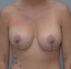 Breast Lift With Implants Before & After Patient #1095