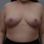 Breast Reduction Before & After Patient #1131