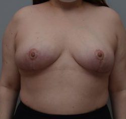 Breast Reduction Before & After Patient #1131