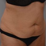 Abdominoplasty Before & After Patient #1443