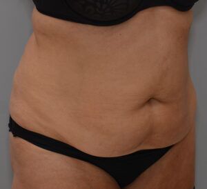 Abdominoplasty Before & After Patient #1443