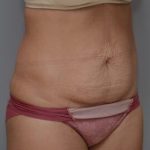 Abdominoplasty Before & After Patient #1442