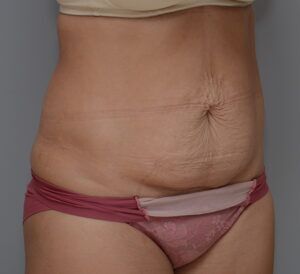 Abdominoplasty Before & After Patient #1442