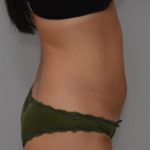 Abdominoplasty Before & After Patient #1441