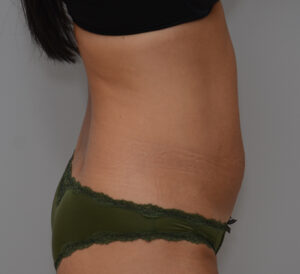 Abdominoplasty Before & After Patient #1441