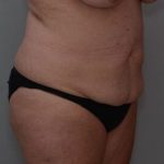 Abdominoplasty Before & After Patient #1444