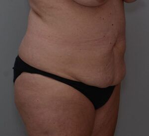 Abdominoplasty Before & After Patient #1444