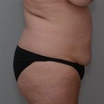 Liposuction with Bodytite Before & After Patient #1556