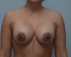 Breast Augmentation Before & After Patient #249