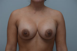 Breast Augmentation Before & After Patient #249