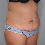 Abdominoplasty Before & After Patient #1273