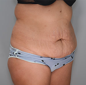 Abdominoplasty Before & After Patient #1273