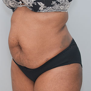 Abdominoplasty Before & After Patient #1384