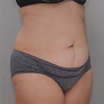 Abdominoplasty Before & After Patient #1383