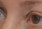 Blepharoplasty Before & After Patient #1701