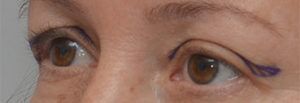 Blepharoplasty Before & After Patient #1701