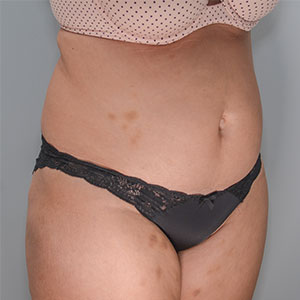 Abdominoplasty Before & After Patient #1329