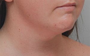 Neck Liposuction Before & After Patient #1951