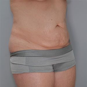 Abdominoplasty Before & After Patient #1272