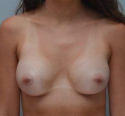 Breast Augmentation Before & After Patient #250