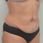 Abdominoplasty Before & After Patient #1386