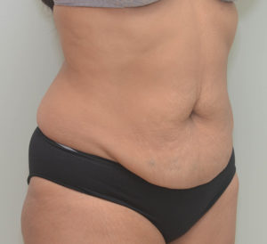 Abdominoplasty Before & After Patient #1386