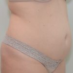 Abdominoplasty Before & After Patient #1385