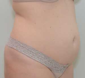 Abdominoplasty Before & After Patient #1385