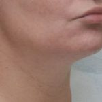 Neck Liposuction Before & After Patient #2003