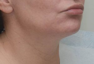 Neck Liposuction Before & After Patient #2003