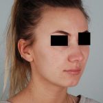 Rhinoplasty Before & After Patient #2113