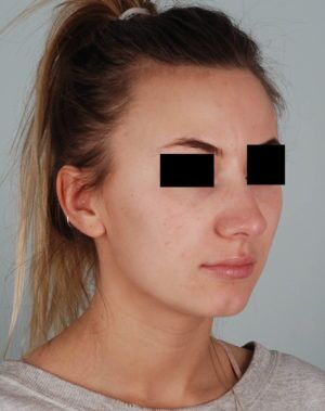 Rhinoplasty Before & After Patient #2113