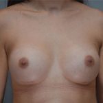 Breast Augmentation Before & After Patient #358