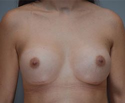 Breast Augmentation Before & After Patient #358